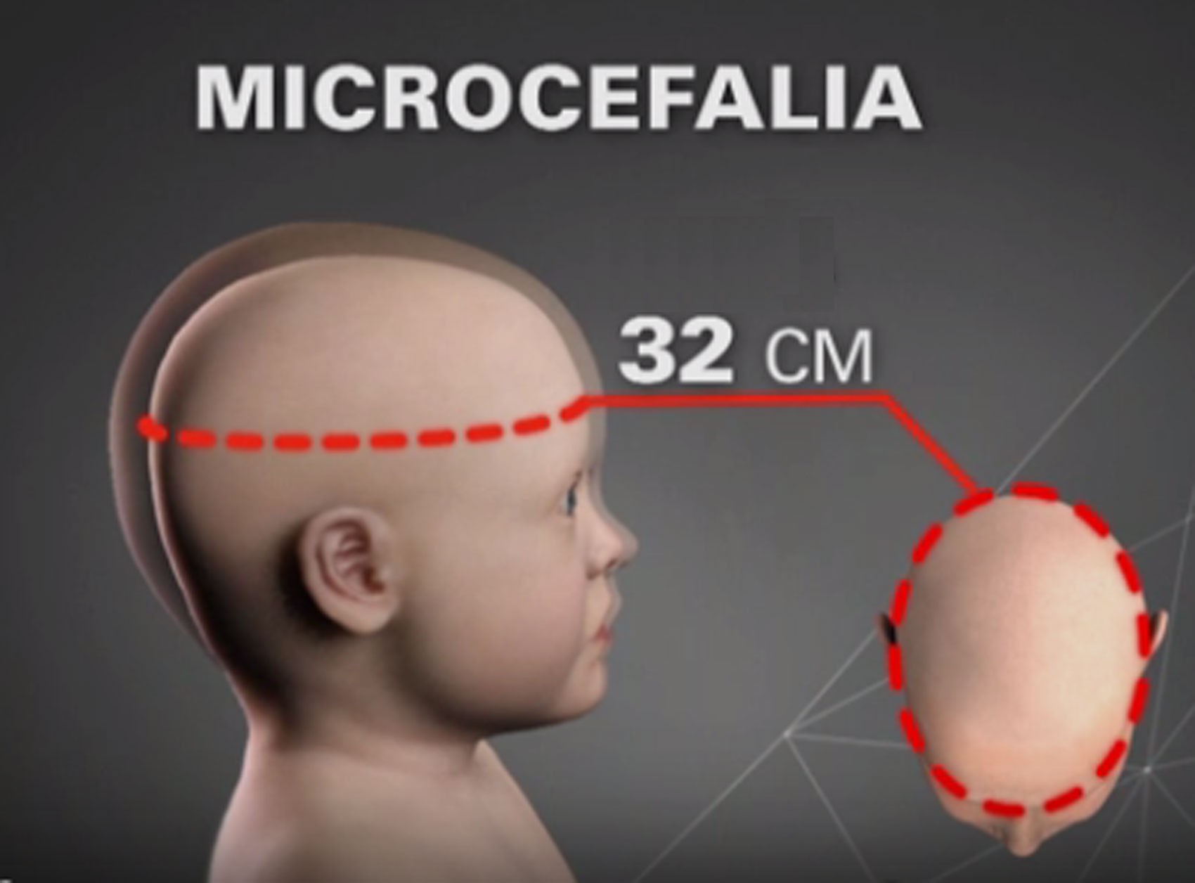 microcefalia