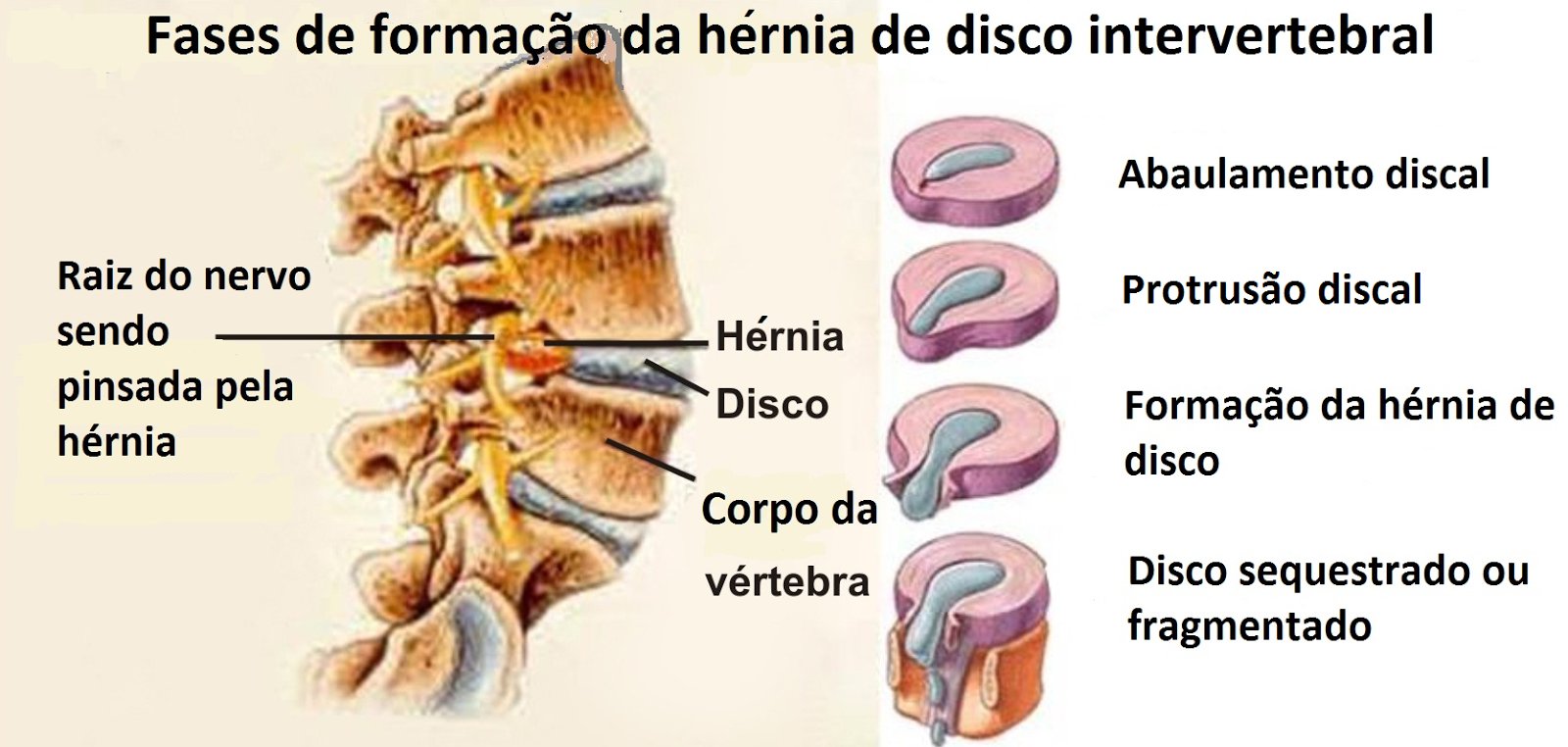 hernia-de-disco