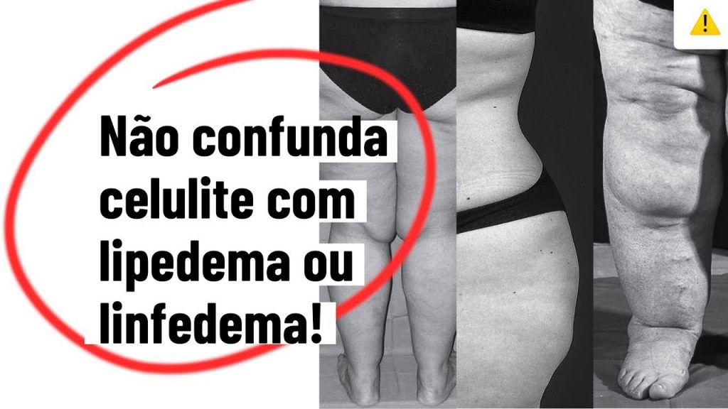 Lipedema nas pernas: o que é, causas, sintomas e tratamento